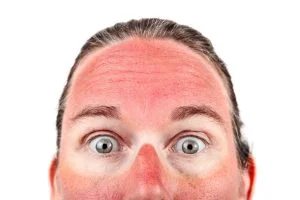  درمان آفتاب سوختگی