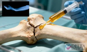 ترمیم شکستگی استخوان چسب زیستی Bone-02.